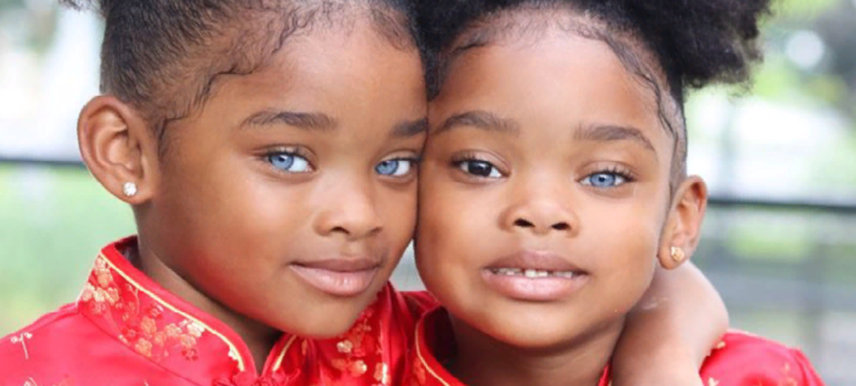 Twins With Amazing Eyes Turned 10 Years Old This Is What They Look 